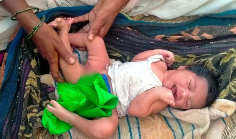 Uttarpradesh: शामली में 3 पैर वाले बच्चे का जन्म, भगवान का अवतार समझ देखने वालों का लगा ताँता
